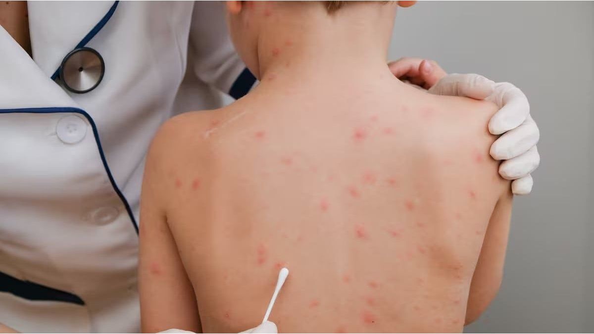 Se reactivó la alerta sanitaria en el país tras la detección de un caso de sarampión en Entre Ríos: los detalles