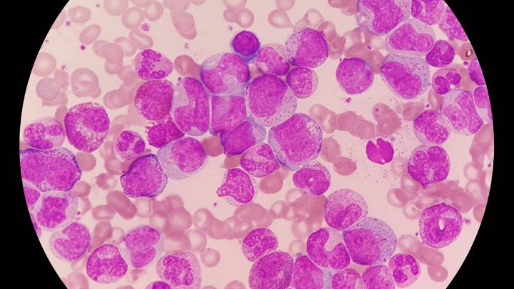Tern leukemia drug results likely to catch investor attention