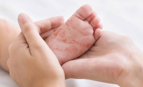 Estados Unidos: más de 250 personas en cuarentena por un brote de sarampión