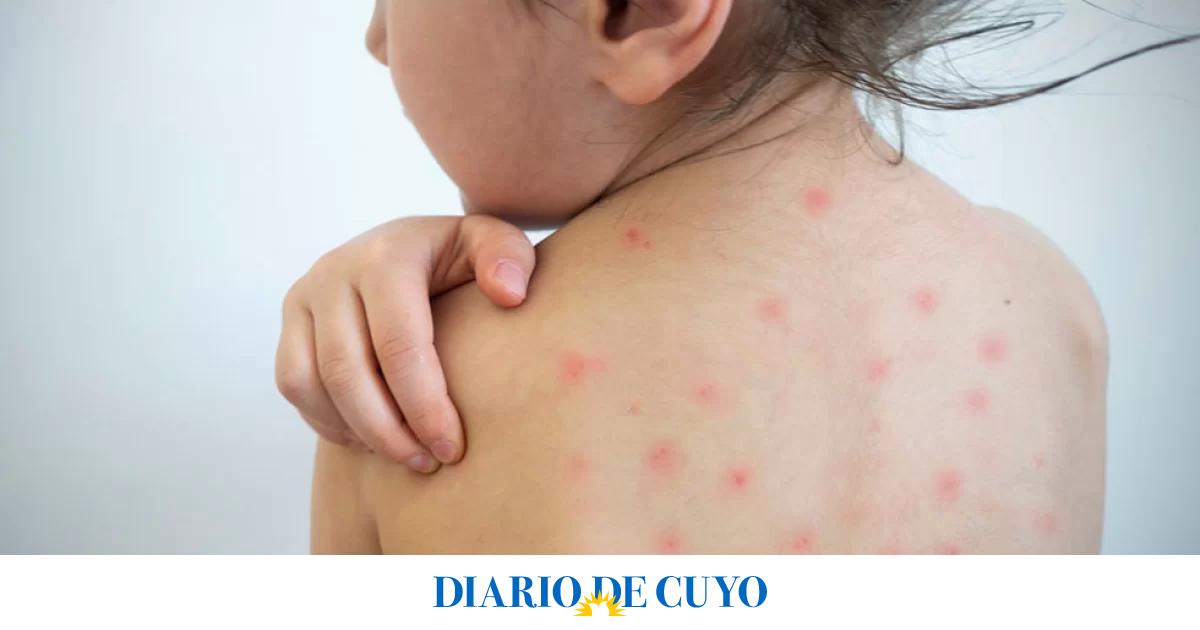Chile declaró alerta sanitaria por sarampión y apuntó al aumento de casos en Argentina