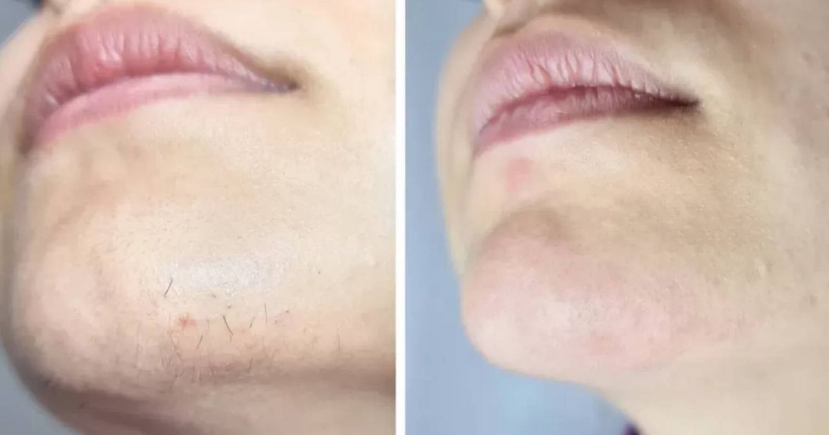 'Best hair removal method I've tried' that's not shaving or waxing but £140 off