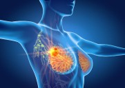 SABCS: Omission of SLNB Safe in Clinically T1