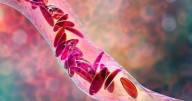 U.S. ERs Are Failing Sickle Cell Patients In Pain, Study Says