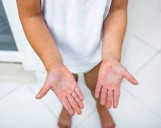 Descarta Salud alerta por virus Mano