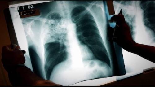 Case of Tuberculosis reported at Farmville Middle School in Pitt County