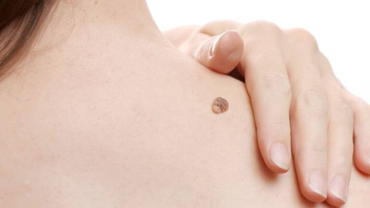 Verrugas: conoce el método más barato para eliminarlas