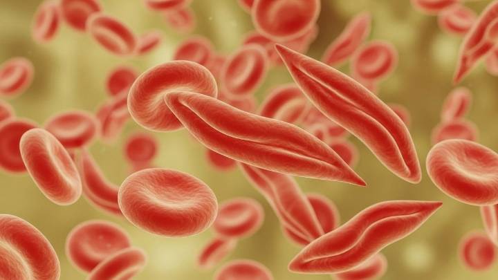 ASH: Iron Overload Prevalent in Sickle Cell Disease