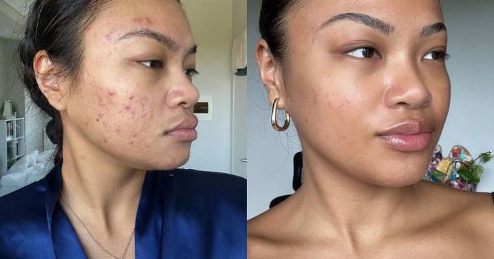 Ex-Boots worker says she 'wishes she had' £13 spot serum when suffering with acne