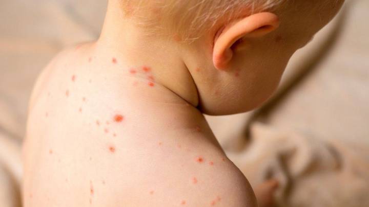 El Ministerio de Salud detectó un caso de sarampión en Entre Ríos y activó una alerta nacional