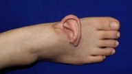 Mujer china tuvo que llevar su oreja implantada en su pie durante meses (+Foto)