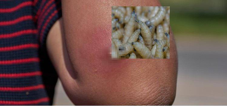 Confirman dos casos de gusano barrenador en humanos en Oaxaca