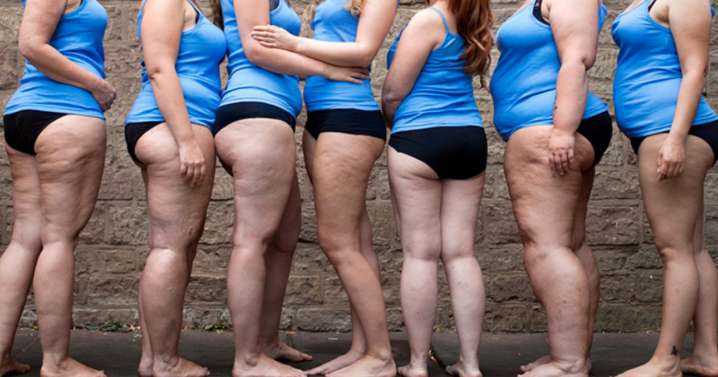 El Hospital de Cuenca alza la voz como referente en el estudio del lipedema desde el Congreso Mundial en Roma