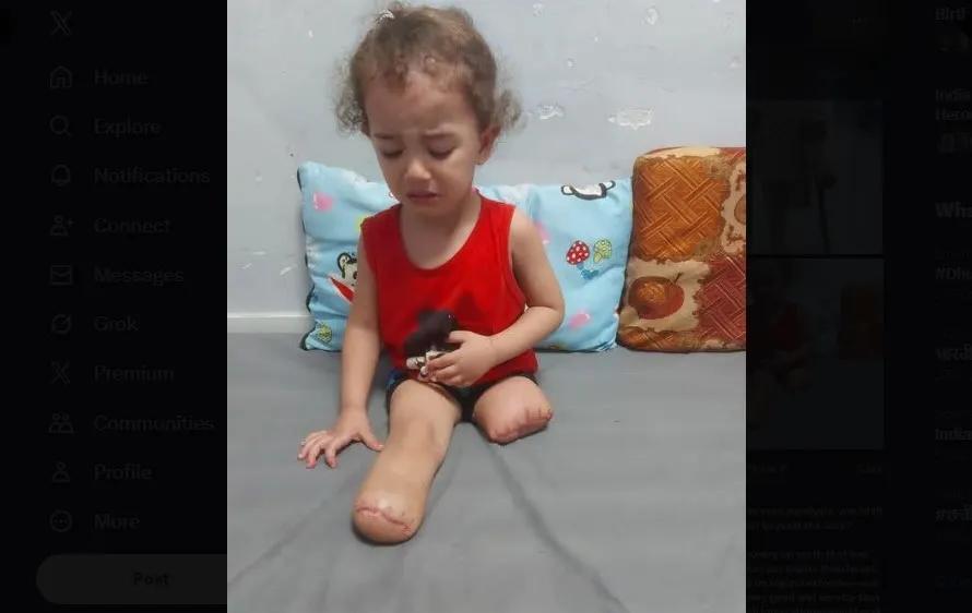 Gaza amputees struggle to rebuild lives as enclave faces shortages of prosthetic limbs