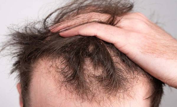 Sorprendente truco para la calvicie: porqué los especialistas hablan del jugo de cebolla