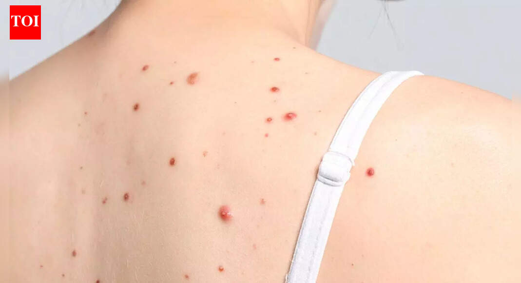 What those tiny red moles on your skin actually mean: Causes, risks and treatment options for cherry angiomas