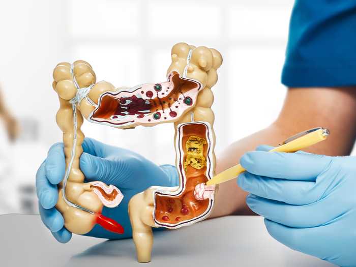 ¿Cáncer colorrectal a los 40? Sí