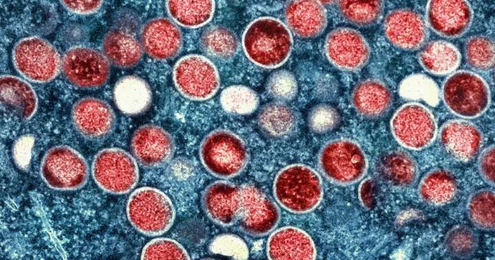 Mpox: U.K. identifies new strain in England