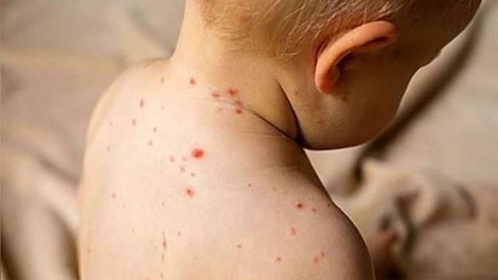 Sarampión: El Ministerio de Salud emitió alerta epidemiológica