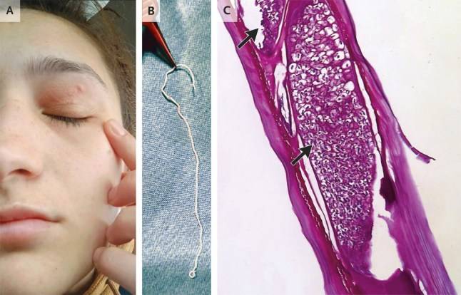 Worm ‘from pet dog’ hatched inside woman’s forehead and then crawled into her eye