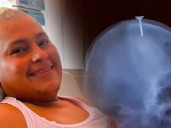 Obrero se salva de milagro luego que clavo se incrustó en su cabeza en Iquitos