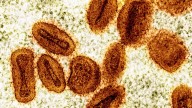 2 mpox cases confirmed in Worcester, Mass. warns of 'concerning' uptick