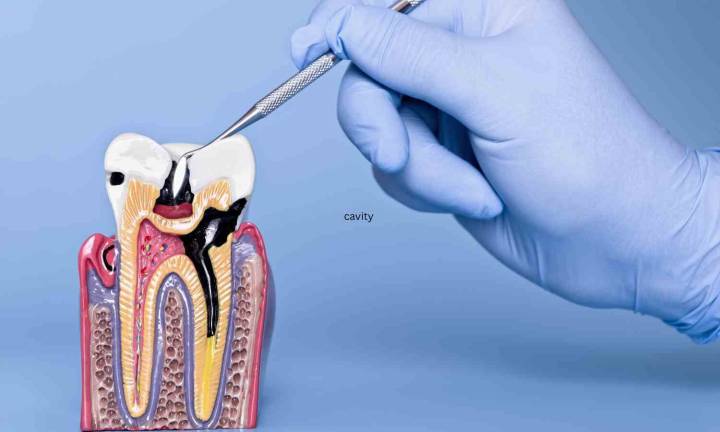 Sweet tooth: How blood sugar migration in diabetes affects cavity development?