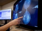 Cáncer de mama: la inteligencia artificial revela lo que los médicos no pueden ver