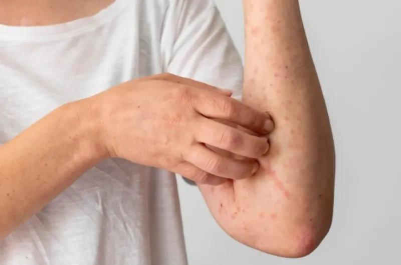 Alarma en EE.UU.: más de 250 personas en cuarentena por un brote de sarampión