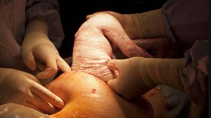 Bajar la cantidad de partos por cesáreas sin preguntar a las que ponen el cuerpo