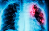 Mantiene Salud Coahuila vigilancia permanente a casos de tuberculosis