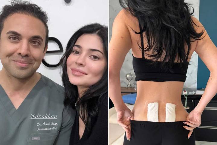 Kylie Jenner Reveals She Underwent Stem Cell Therapy for Back Pain