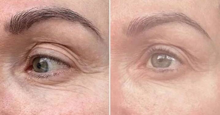 Former NHS GP urges 'try £37 routine for fine lines before botox'
