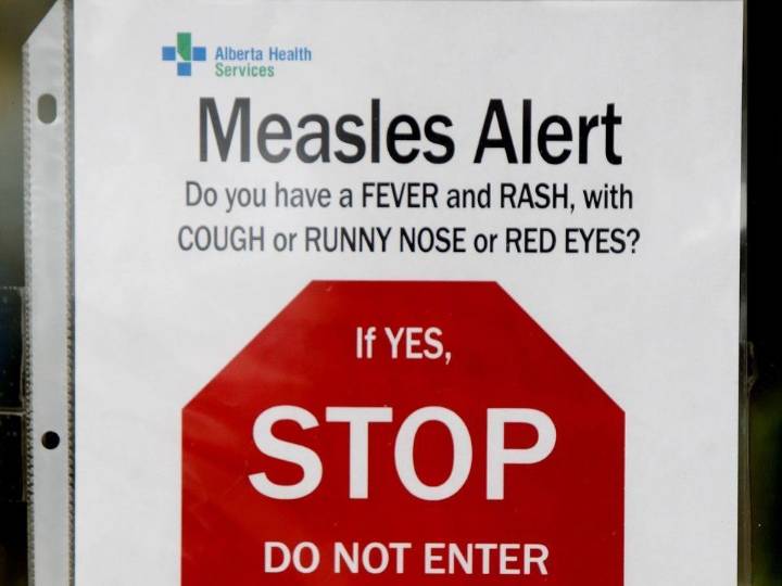 Measles case at Edmonton airport prompts alert