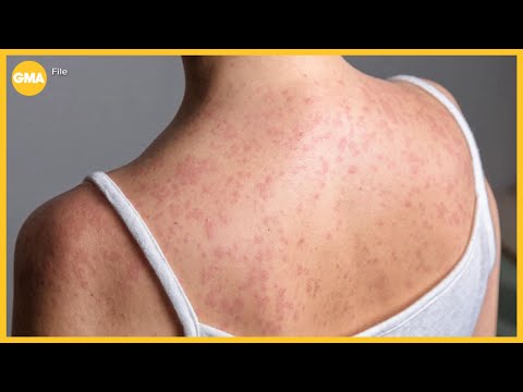 Hundreds quarantined amid growing measles outbreak