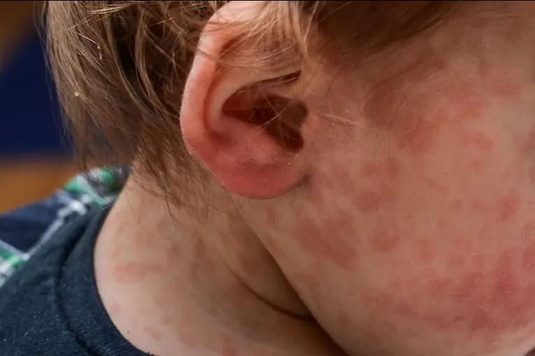 Se confirmó un caso de sarampión en Entre Ríos y se convocó una comisión de vigilancia