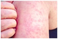 Primer caso de sarampión en Bahía de Banderas: confirman contagio en Valle Dorado y activan cerco sanitario