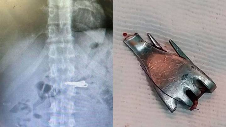 Santa Fe: un preso de alto perfil se tragó un tenedor y terminó internado bajo custodia extrema