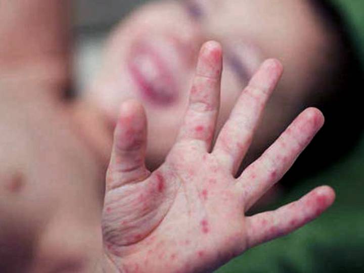 Se reactivó la alerta sanitaria en el país tras la detección de un caso de sarampión en Entre Ríos