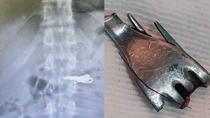 Santa Fe: un preso peligroso se tragó un tenedor y tuvo que ser internado