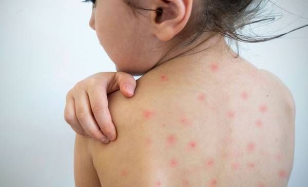 Riesgo antivacunas: decretaron cuarentena en Estados Unidos por un brote de sarampión