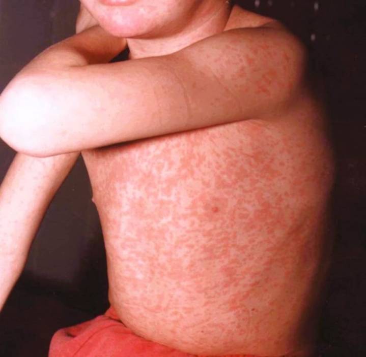 Detectaron un nuevo caso de sarampión en Entre Ríos y se reactivó la alerta a nivel nacional