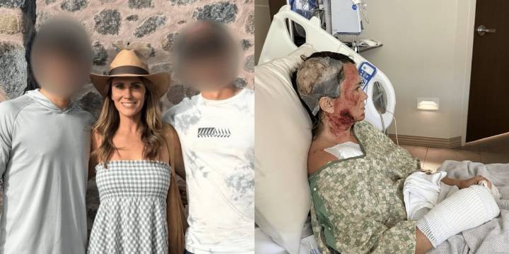 Savannah woman attacked with acid, recovering at Augusta burn center