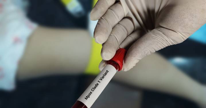 Symptoms of mpox amid 'concern' over new virus strain detected in England