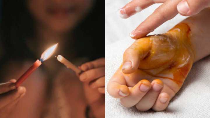 Diciembre y día de las velitas en Colombia: ¿qué hacer y qué no hacer en caso de una quemadura?