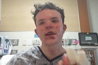 Boy Speaks Out After He Was Severely Burned by Bonfire