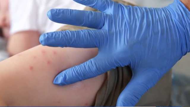 Measles exposure reported at four schools in Spartanburg County