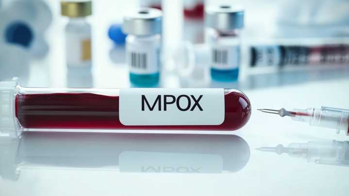 Identifican nueva cepa recombinante de mpox en Inglaterra