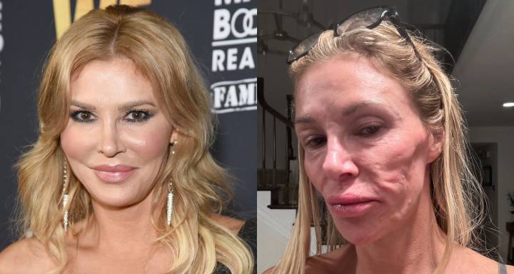Brandi Glanville Says She ‘Finally’ Got a Diagnosis After Battling Suspected Face ‘Parasite’ | Brandi Glanville