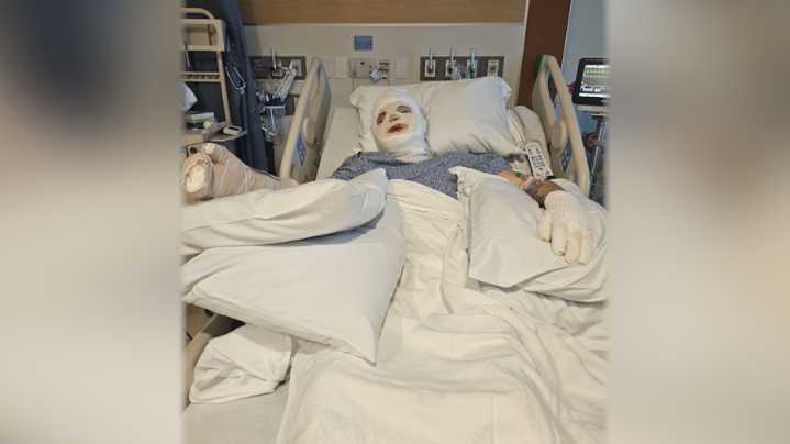 Gloucester teenager warns others about fire safety after fiery accident