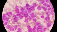 Tern leukemia drug results likely to catch investor attention